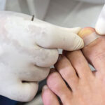 Orteses-Unha-Encravada